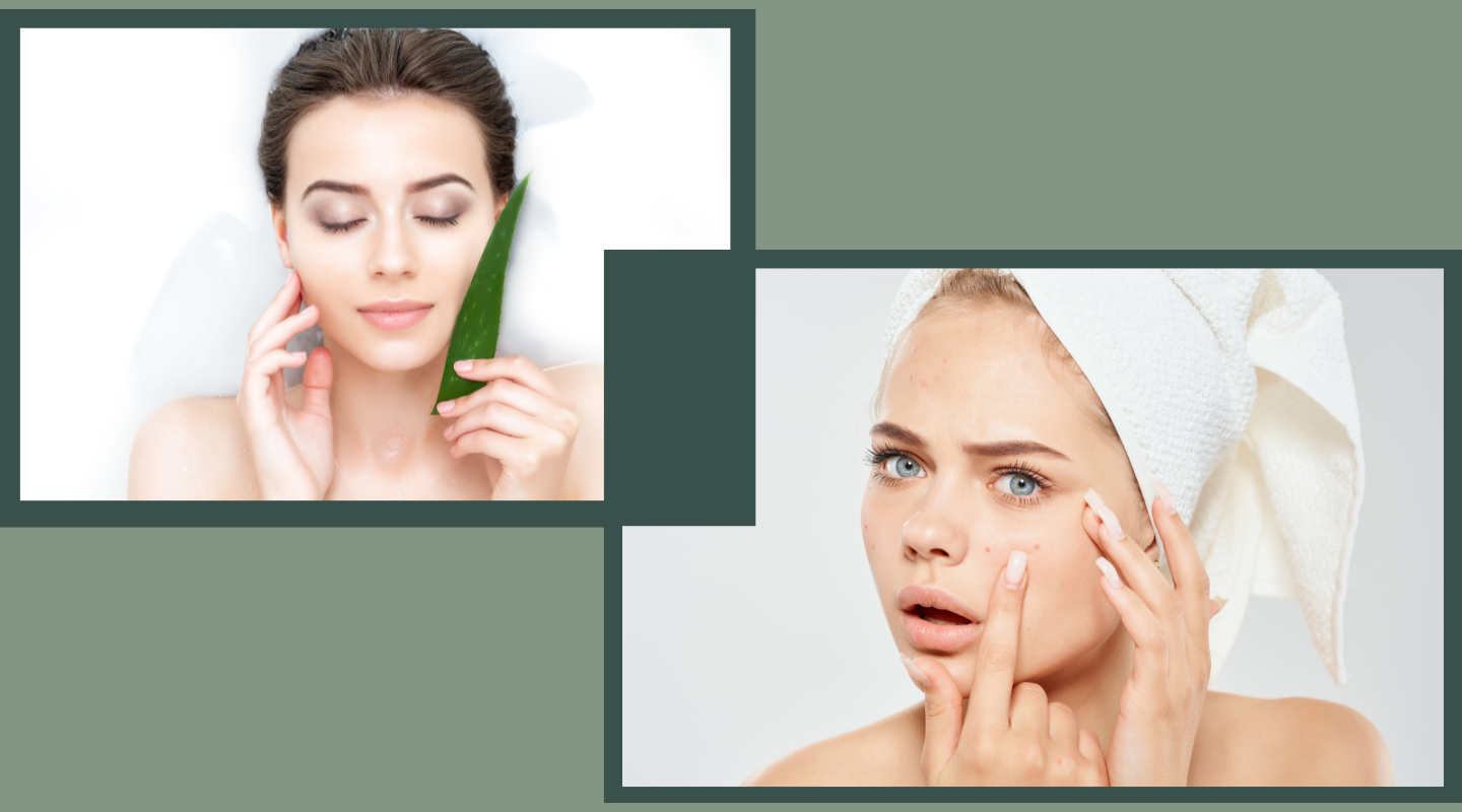 Say Goodbye to Acne with Aloe Vera: Nature's Miracle Healer!